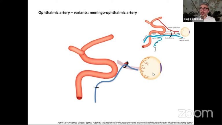 ECA Dangerous Anastomosis: Key Anatomy and Clinical Cases