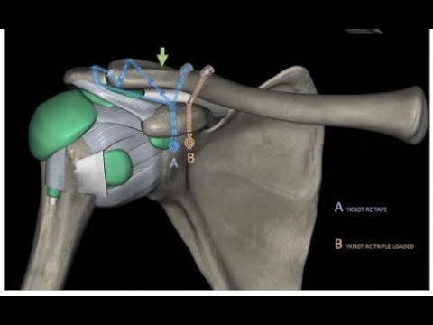 AC Joint: Closing the Circle Techique